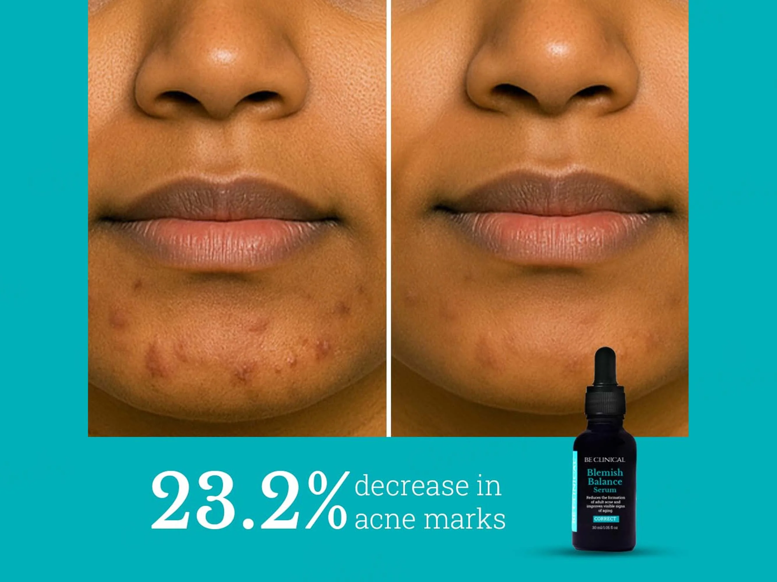 Be Clinical Blemish Balance Serum - Image 2