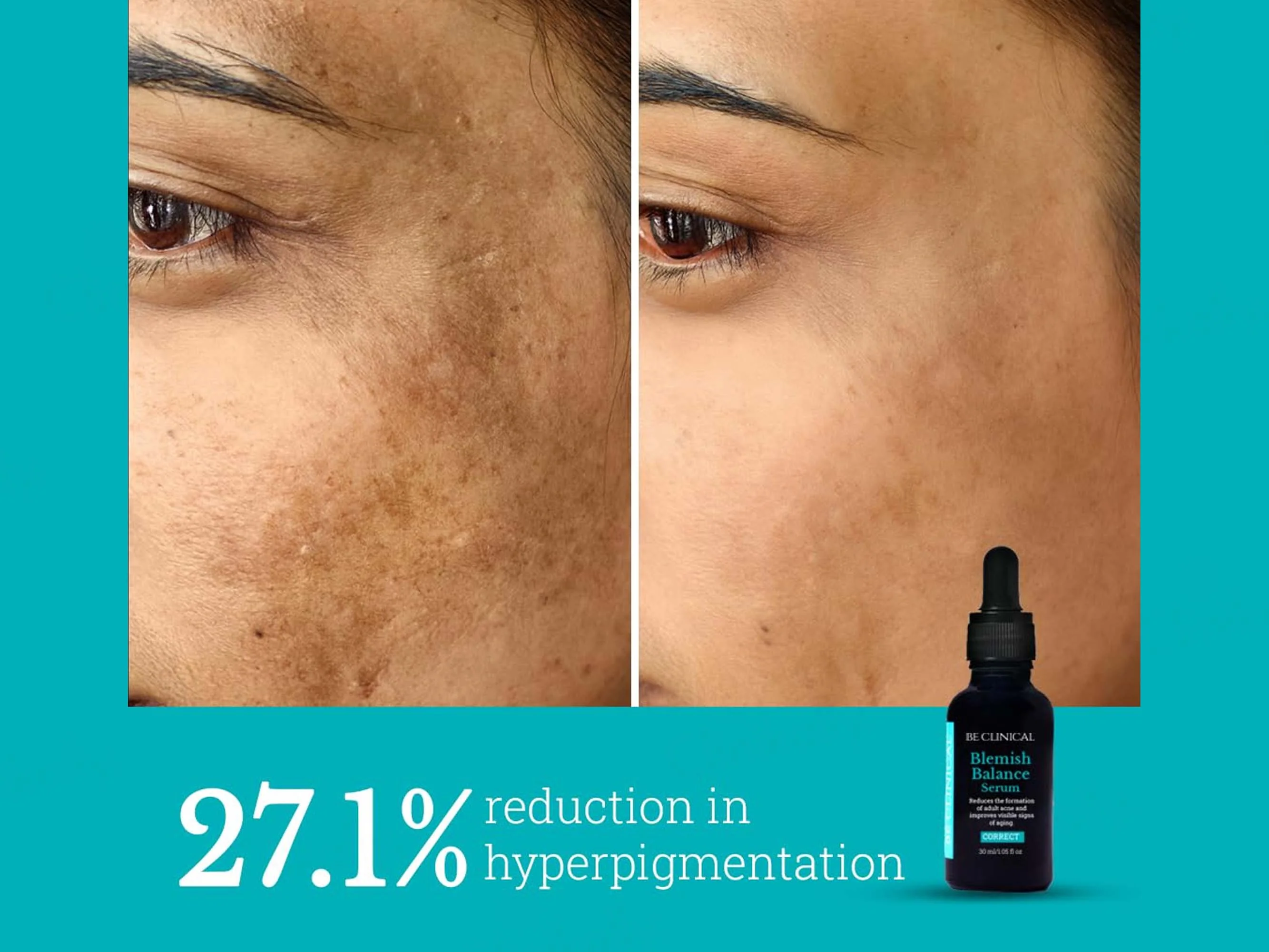 Be Clinical Blemish Balance Serum - Image 3