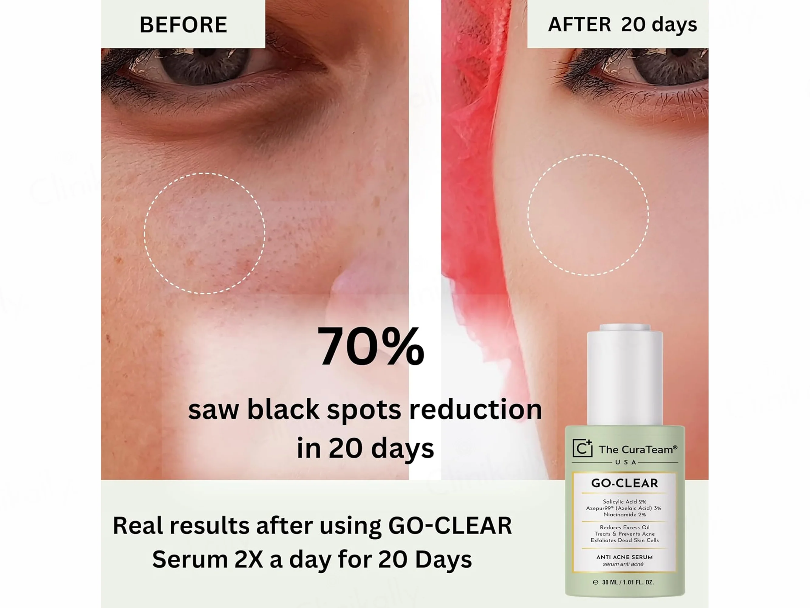 The CuraTeam Go-Clear Anti Acne Serum - Image 6