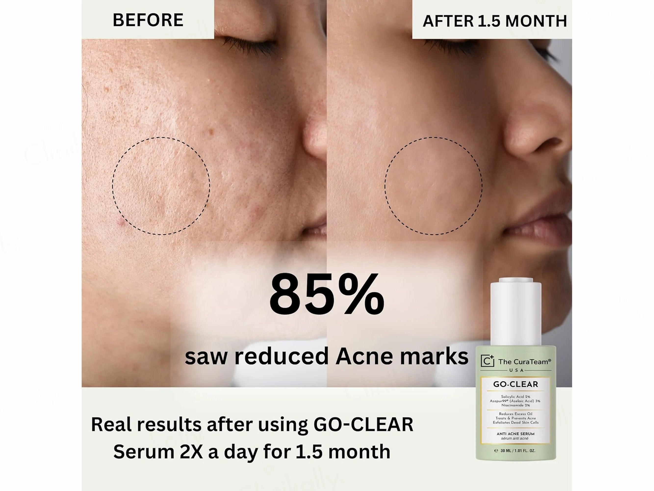The CuraTeam Go-Clear Anti Acne Serum - Image 7